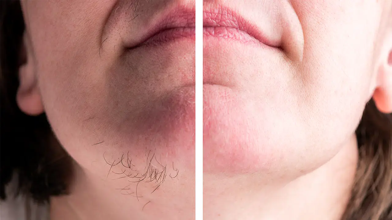 epilation-laser-menton-femme (1)